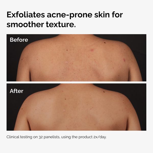 Salicylic Acid 0.5% Body Serum - Image 2